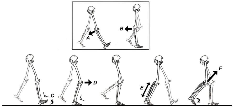 Gait Retraining For Knee Hyperextension Human Locomotion