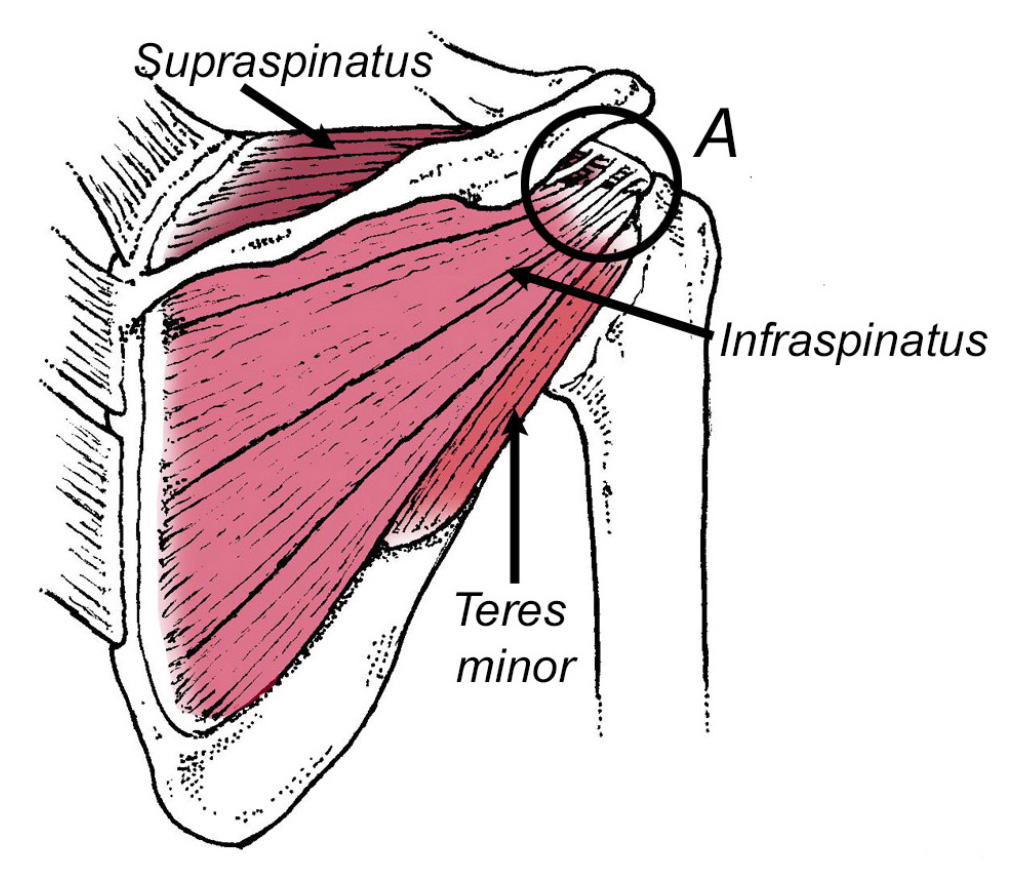 supraspinatus muscle tear
