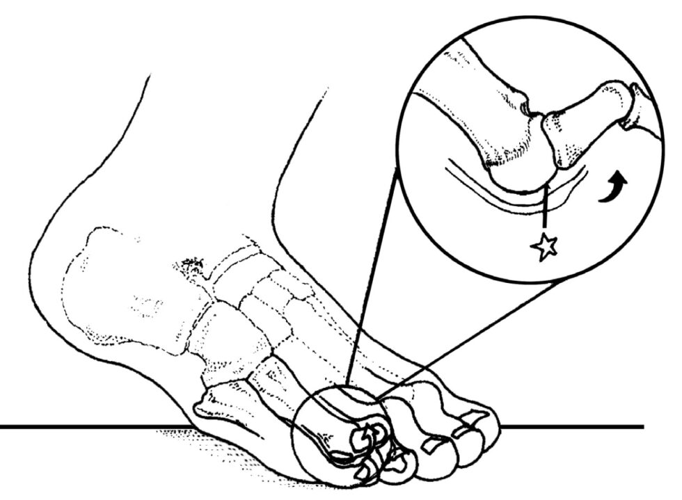 The Peel and Stick Interdigital Neuroma Balance - Human Locomotion