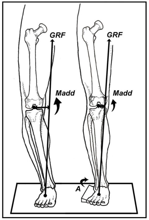 Varus and Valgus Insole Posting: An Inexpensive and Effective ...