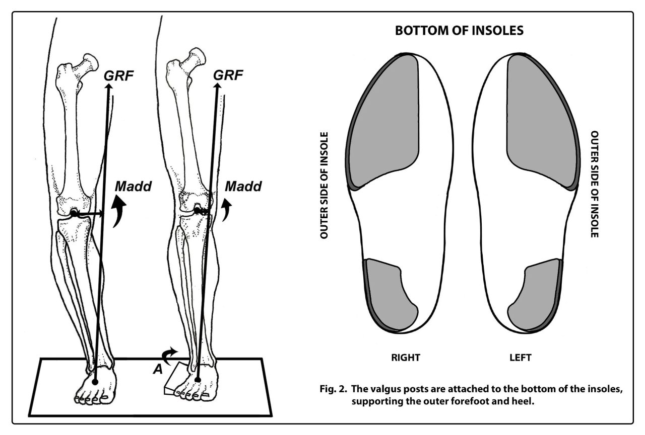 PEEL and STICK POSTS: Forefoot and Rearfoot Valgus Posts - Human Locomotion