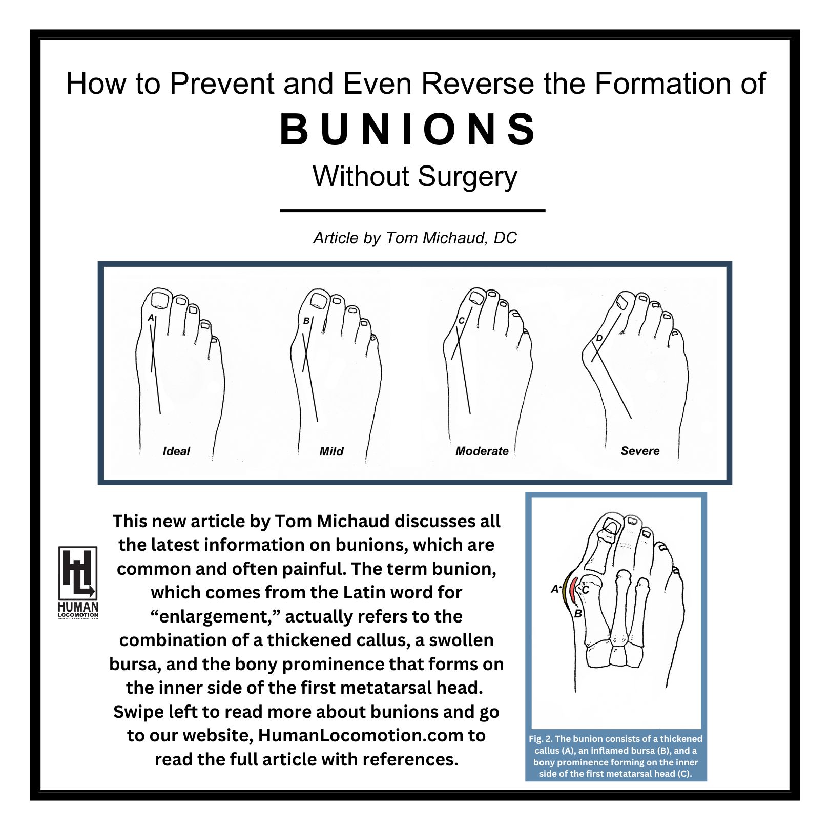 How to Prevent and Even Reverse the Formation of Bunions Without Surgery